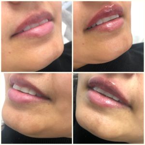 Lip Filler 0.5ml